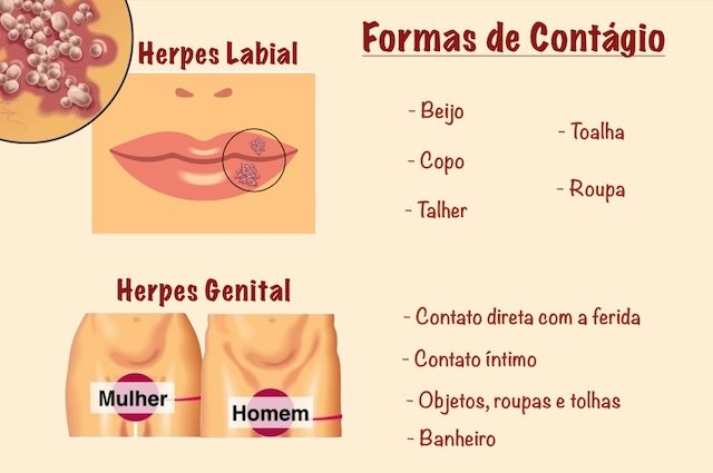herpes labial e genital