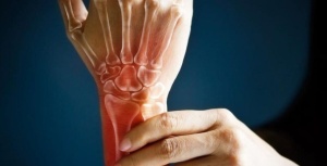 artrite reumatoide sintomas