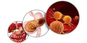 câncer no pâncreas sintomas e causas